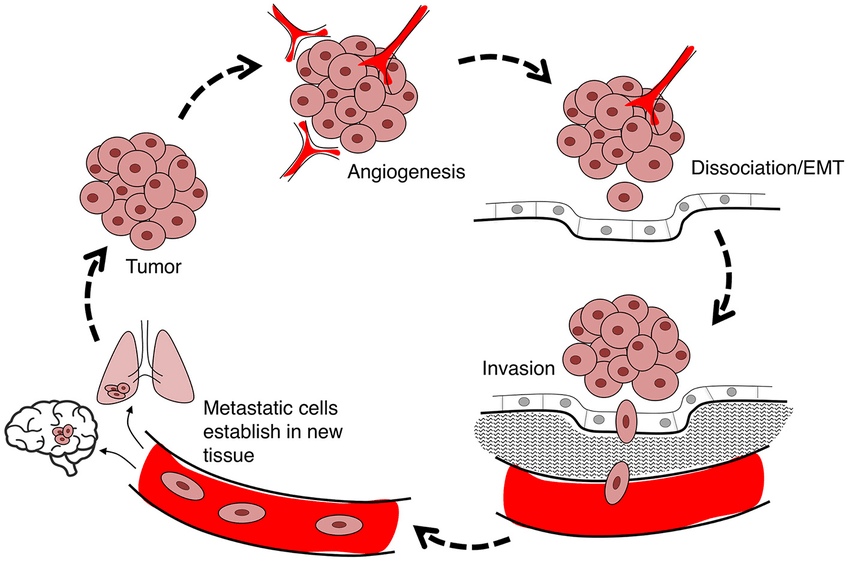 Malignant Neoplasm Adalah Kanker: Pengertian Lengkap